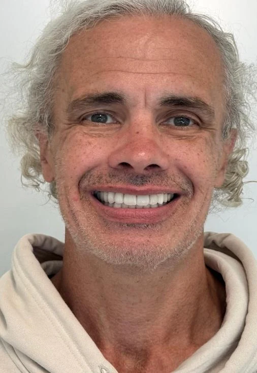 The same patient smiling after cosmetic treatment