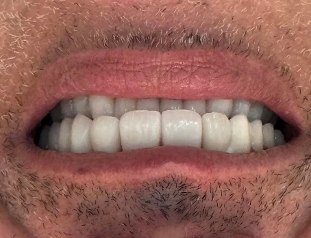 Restored teeth after treatment