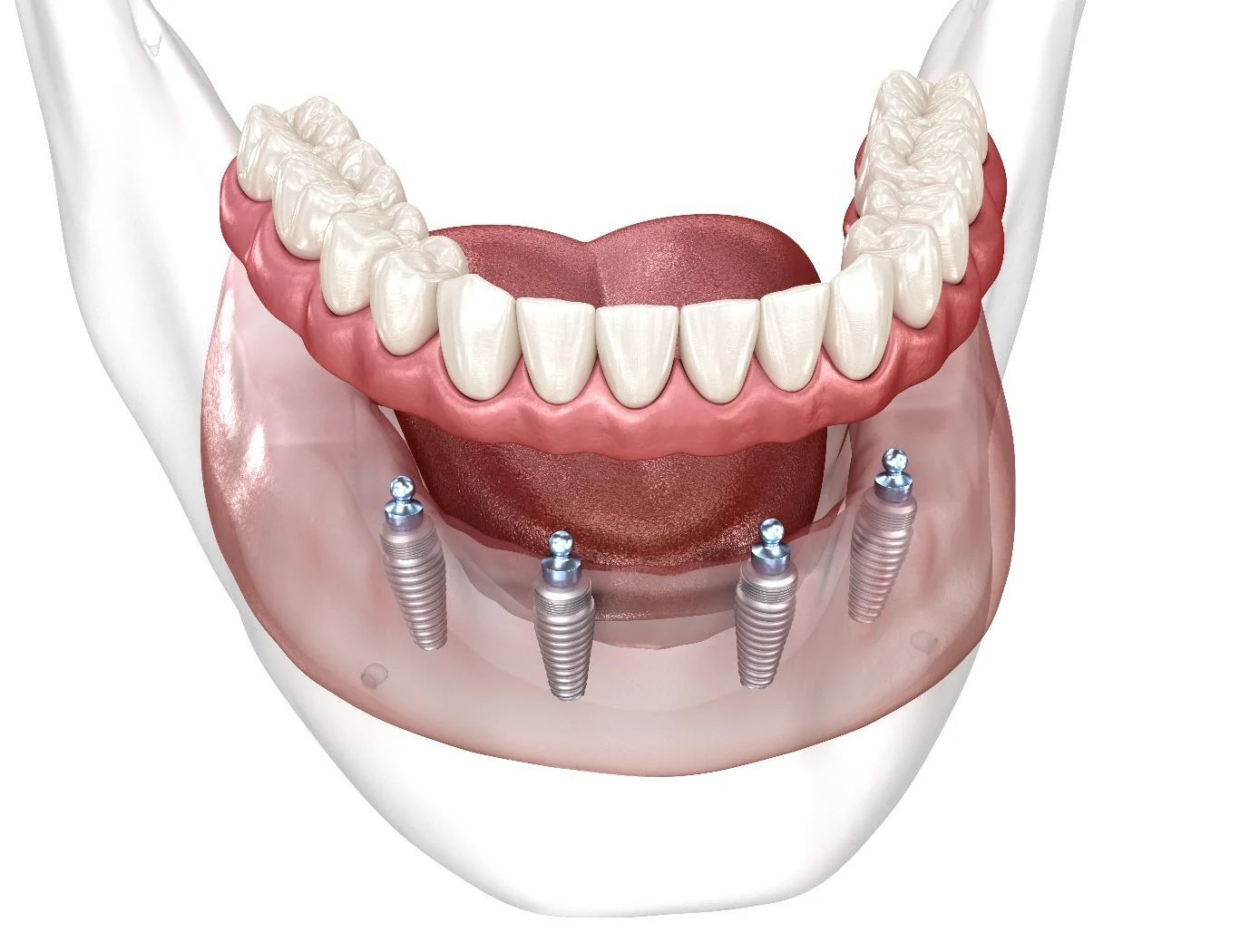 Illustration of an implant-supported denture