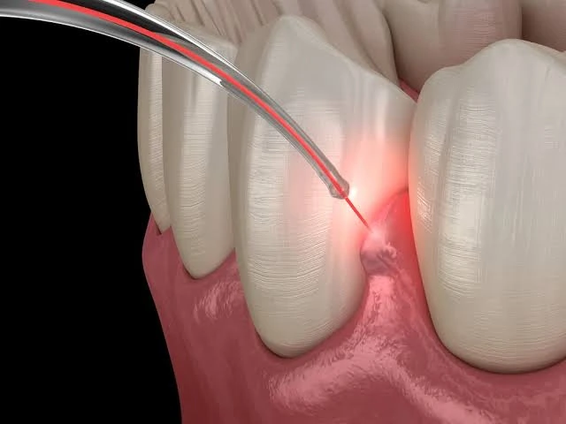 Illustration of a fine laser fibre treating infected gum tissue between two teeth