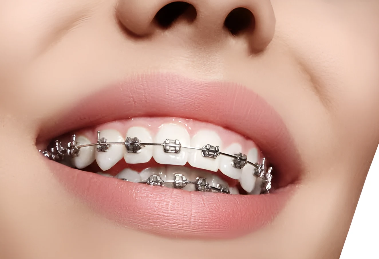 Close-up of a smile with metal braces