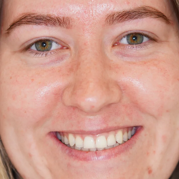 Patient 1 smiling after treatment
