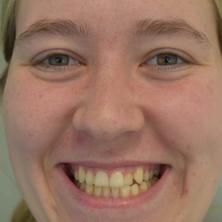 Patient 1 smiling before treatment