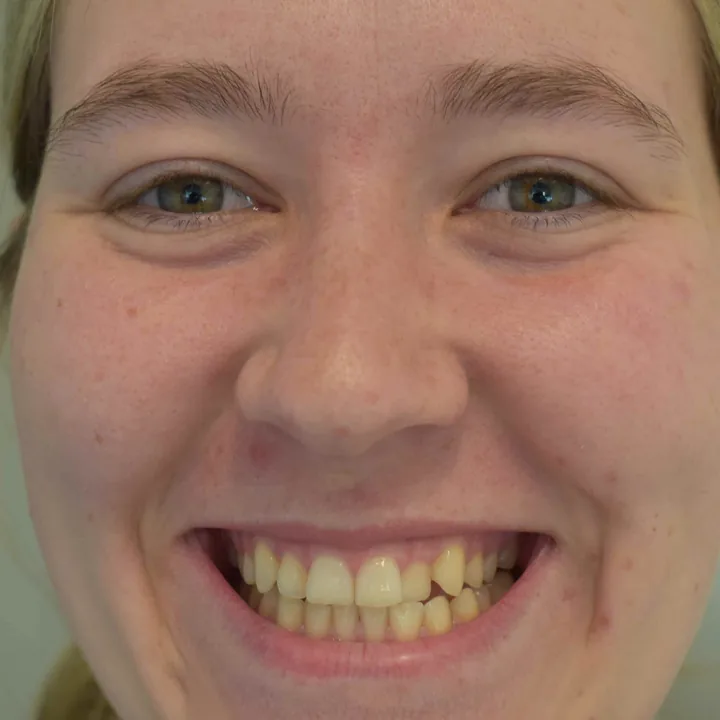 Patient 1 smiling before treatment