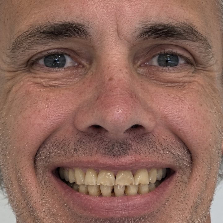 Patient 3 smiling before treatment