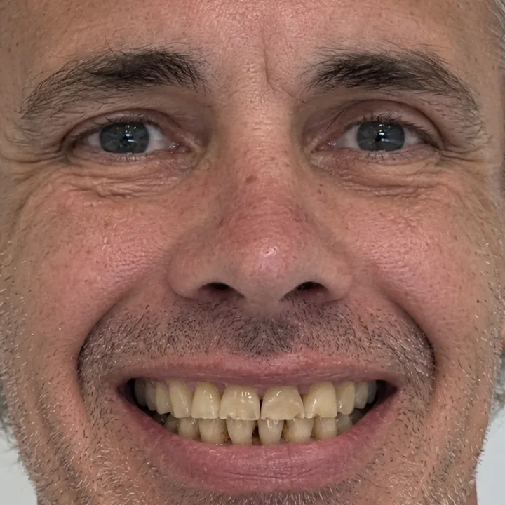 Patient 3 smiling before treatment